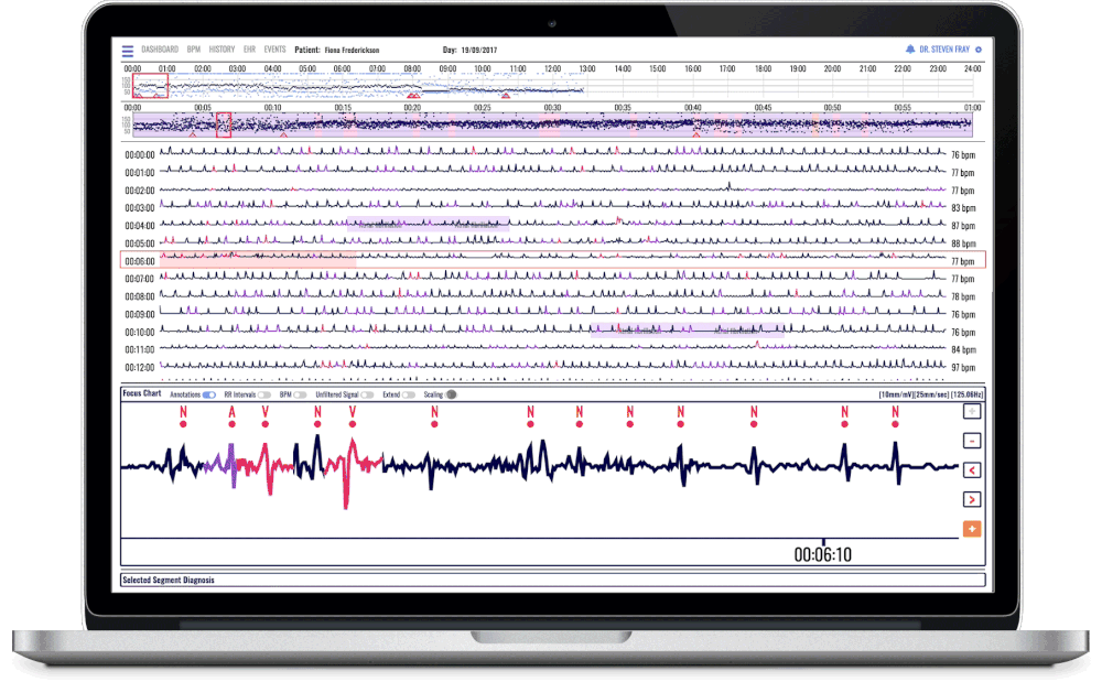 ECG analysis visualization